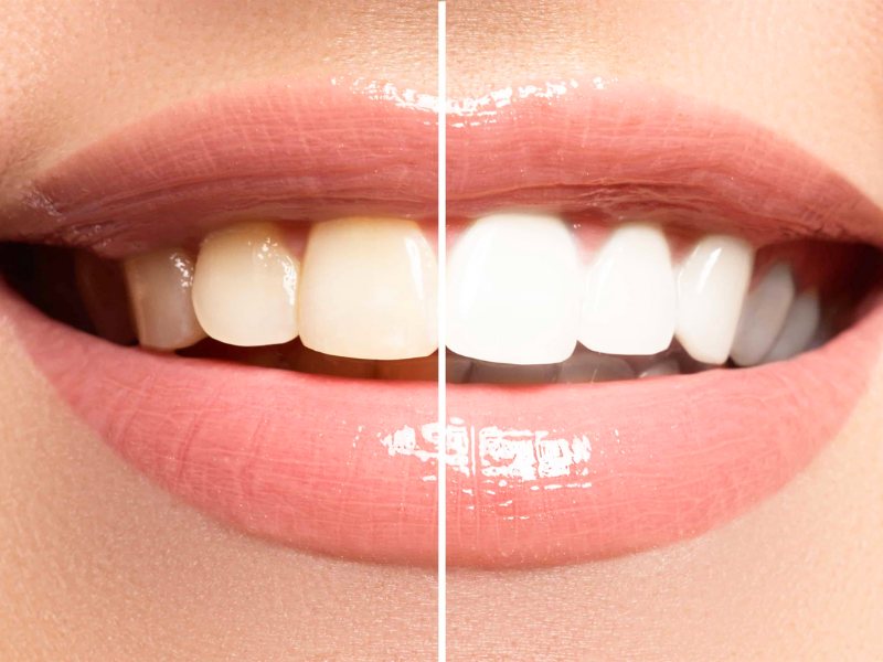 Teeth Whitening